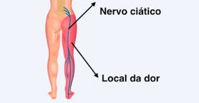 Imagem notícia Nervo ciático: o que é, sintomas e tratamentos