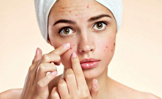 Imagem notícia SAÚDE Oito erros que podem agravar a acne